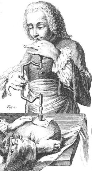Trepanation_illustration_France_1800s (300x557).jpg